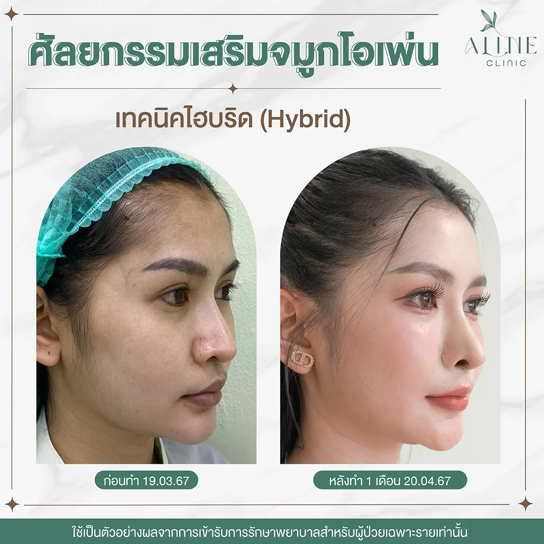 รีวิวเสริมจมูกเทคนิค